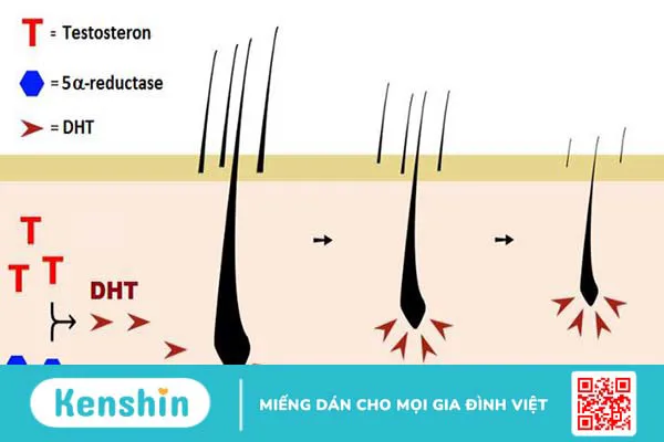 Hormone DHT là gì? Những điều cần biết về DHT và rụng tóc 2