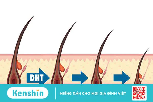 Hormone DHT là gì? Những điều cần biết về DHT và rụng tóc 1