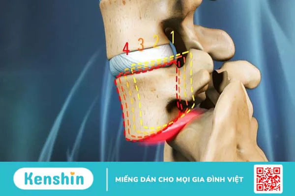 Hướng dẫn một số bài tập chữa trượt đốt sống lưng an toàn và hiệu quả 1