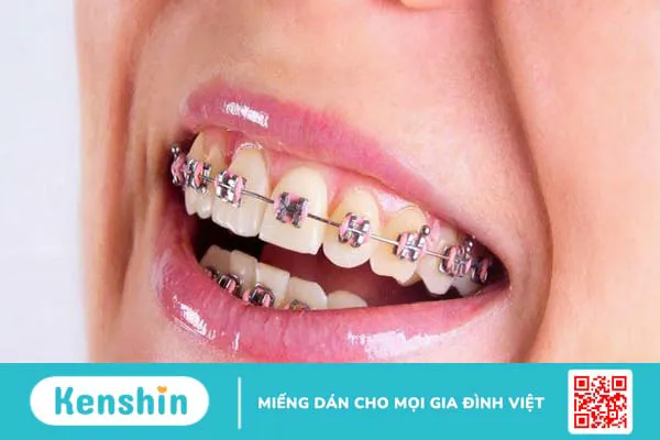 Khám phá giai đoạn xấu nhất khi niềng răng và cách vượt qua 1