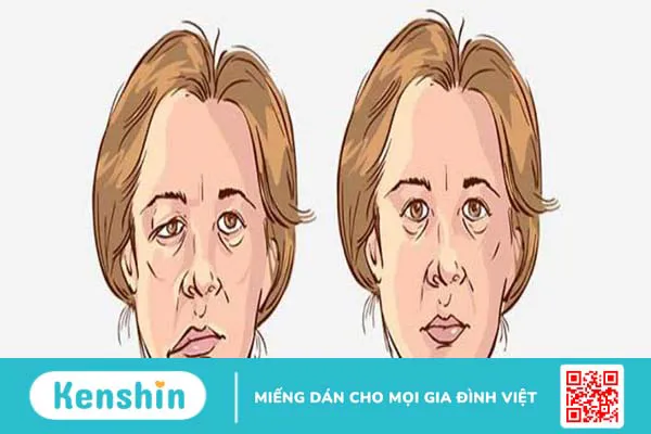 Liệt mặt trung ương: Nguyên nhân, triệu chứng và biện pháp phòng ngừa 1