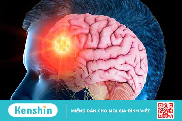 Liệt mặt trung ương: Nguyên nhân, triệu chứng và biện pháp phòng ngừa 2