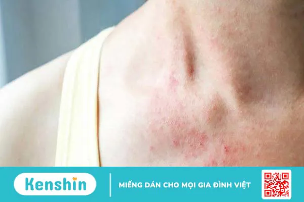 Những điều cần biết về liệu pháp huyết tương hồi phục 2