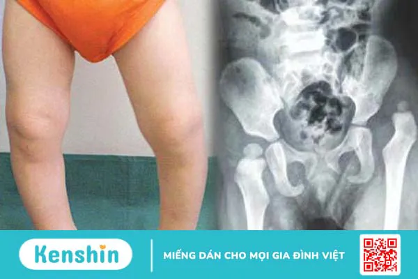 Loạn sản khớp háng có nguy hiểm không? -1