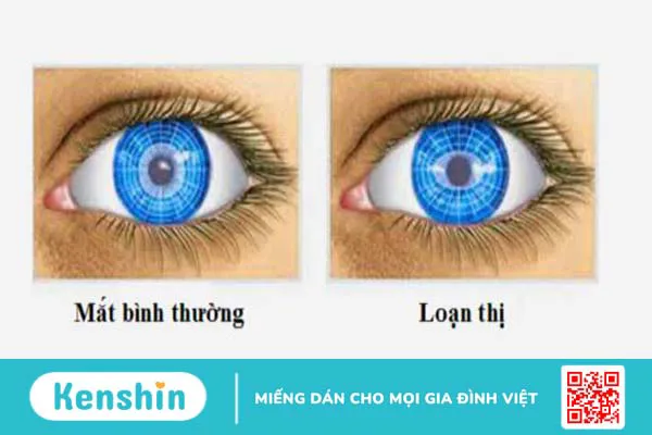 Loạn thị một bên mắt là gì? Điều trị như thế nào?