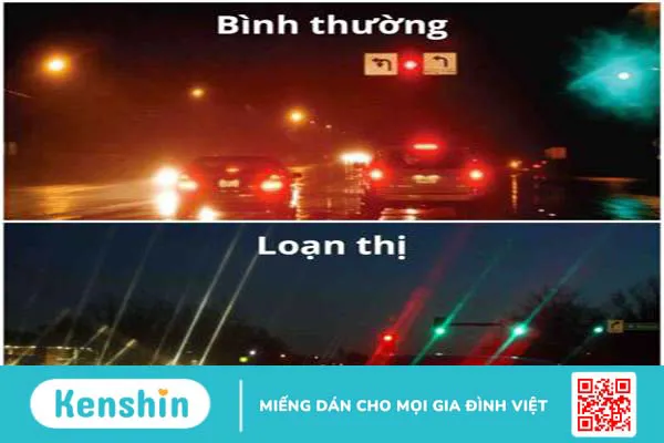 Loạn thị một bên mắt là gì? Điều trị như thế nào?