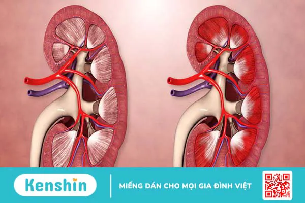 Bệnh cầu thận xảy ra khi có tổn thương đối với cấu trúc cầu thận, gây thay đổi trong chức năng của cầu thận