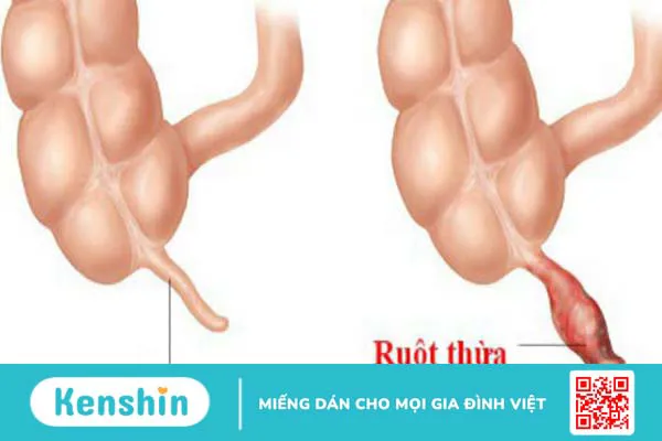 Mổ ruột thừa bao lâu thì cắt chỉ? Cách chăm sóc vết thương