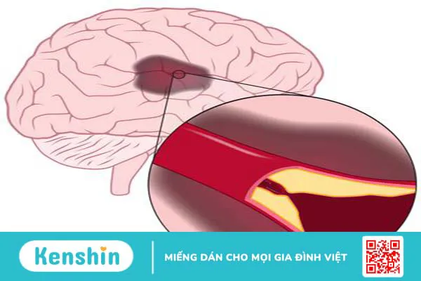 Một số cách trị thiếu máu não tại nhà mà bạn cần biết1