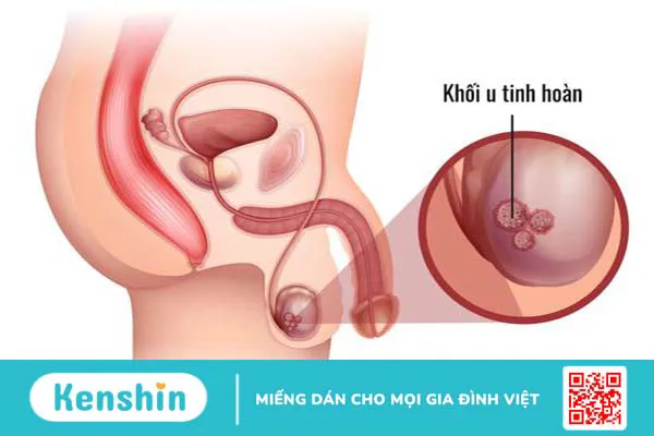 Một số bệnh lý có liên quan đến một tinh hoàn có cục nhỏ rắn không đau 3