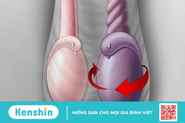 Một số bệnh lý có liên quan đến một tinh hoàn có cục nhỏ rắn không đau 2