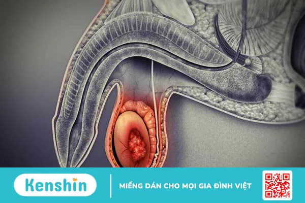 Một số bệnh lý có liên quan đến một tinh hoàn có cục nhỏ rắn không đau 1