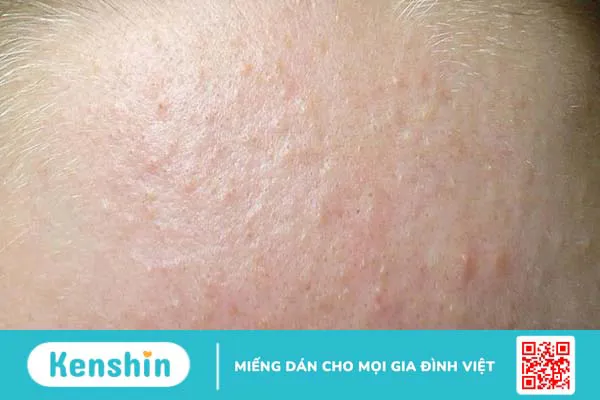 Mụn li ti: Nguyên nhân và cách điều trị 1