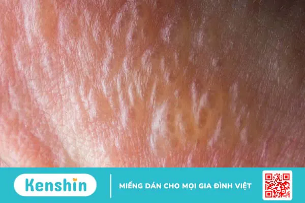 Mụn nước là gì? Cách điều trị hiệu quả 1