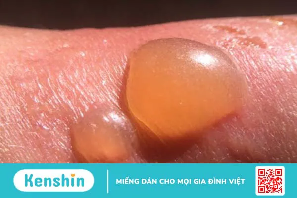 Mụn nước là gì? Cách điều trị hiệu quả 2