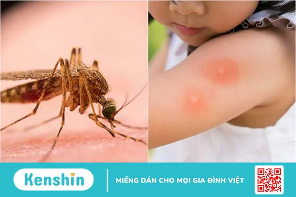 Mụn nước là gì? Cách điều trị hiệu quả 3