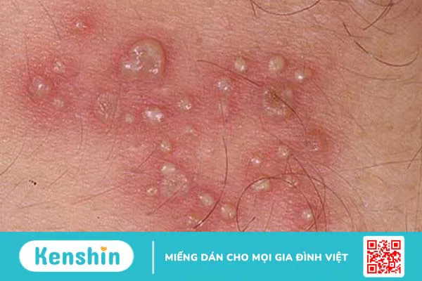 Mụn nước là gì? Cách điều trị hiệu quả 4