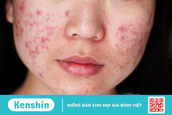 Nặn mụn có nên nặn hết máu không và cần lưu ý điều gì khi nặn mụn? 2