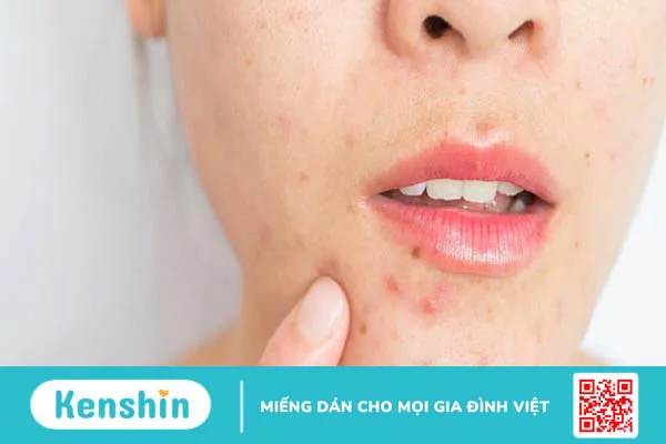 Nặn mụn đinh râu có bị méo mồm hay không?