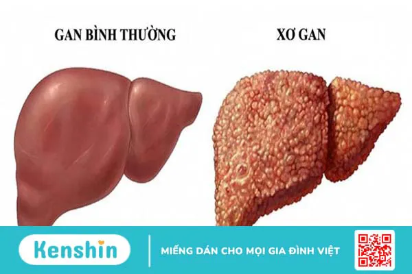 Bụng dưới cứng có nguy hiểm không? -3