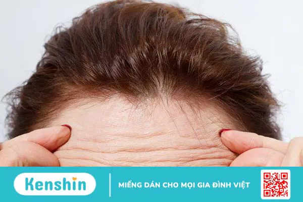 Nguyên nhân phổ biến gây xuất hiện nếp nhăn trên trán 1