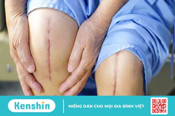 Nhiễm trùng khớp giả: Nguyên nhân, triệu chứng và cách điều trị 2