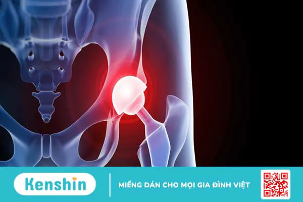 Nhiễm trùng khớp giả: Nguyên nhân, triệu chứng và cách điều trị 3