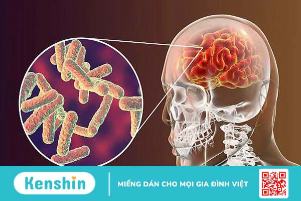 Nhiễm trùng não: Nguyên nhân và triệu chứng nhận biết 1