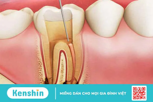 Nhiễm trùng răng: Nguyên nhân và các dấu hiệu nhận biết 1