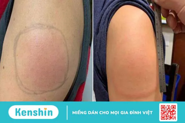 Những điều bạn cần biết về vắc-xin Euvax B 4