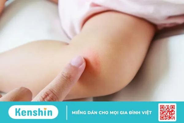 Những nguyên nhân gây nổi mề đay thường gặp 2