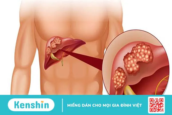 Nổi hạch ở xương sườn phải: Nguyên nhân và cách điều trị 3