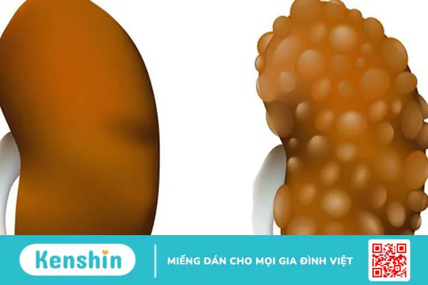 Bệnh thận đa nang bẩm sinh có thể gây thiểu ối 5