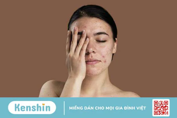 Phác đồ điều trị da nhiễm corticoid an toàn hiệu quả 1