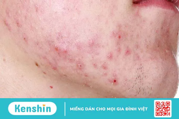 Hình ảnh mụn nội tiết xuất hiện ở cằm và xương hàm