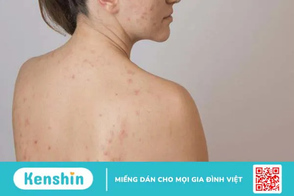 Mụn nội tiết ở lưng gây bất tiện trong việc điều trị mụn