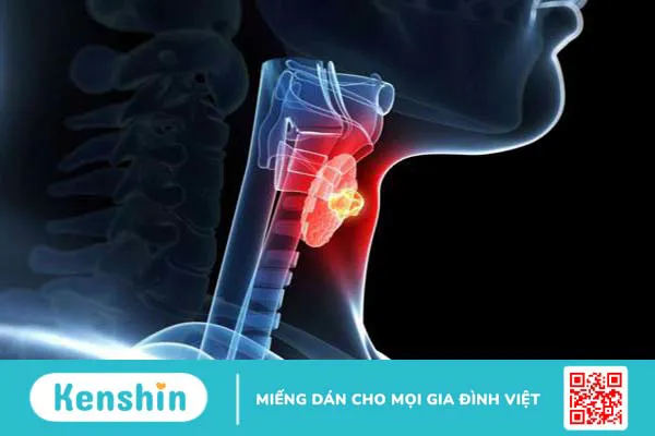 Phân loại tirads trong siêu âm tuyến giáp 5