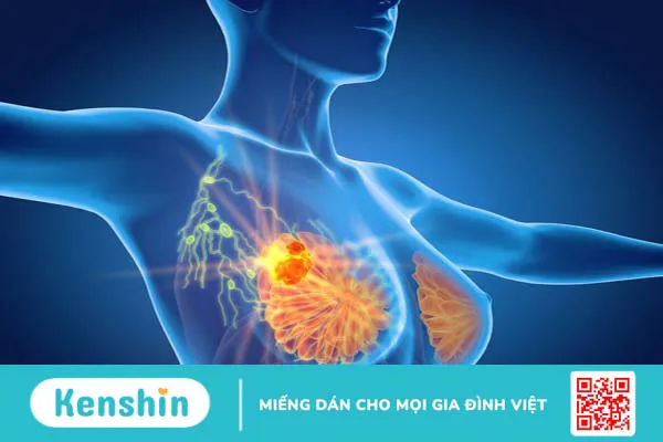 Phẫu thuật định vị kim dây trong vú là gì? 1