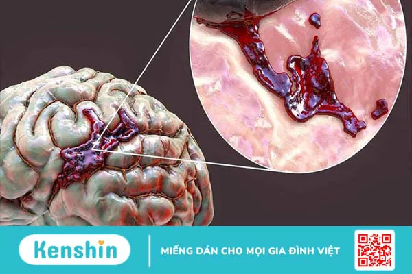 Phẫu thuật giảm áp trong đột quỵ xuất huyết não được chỉ định trong trường hợp nào?  1