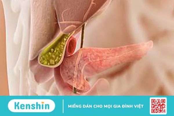 Sỏi mật nếu không được phát hiện sớm, bệnh có thể dẫn đến những biến chứng nguy hiểm