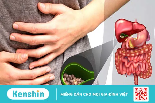 Khi gan tiết ra quá nhiều cholesterol mà mật không thể hòa tan, lượng cholesterol dư thừa có thể kết tinh và tạo thành sỏi