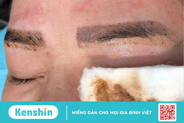 Quy trình xóa chân mày bằng laser như thế nào? Có đau không? 2