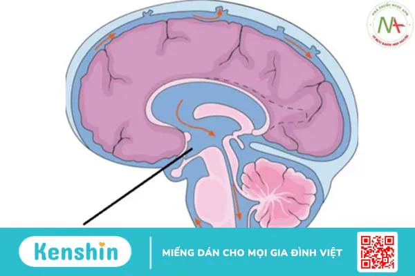 Rò dịch não tủy qua đường mũi là tình trạng gì?