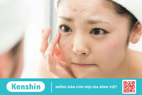 Sau khi nặn mụn có nên rửa mặt bằng nước muối không? -3