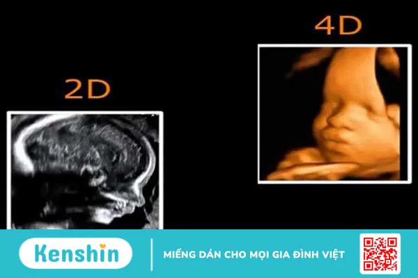 Siêu âm 2D và 4D cái nào chính xác hơn? Siêu âm 2D và 4D khác nhau thế nào? 2