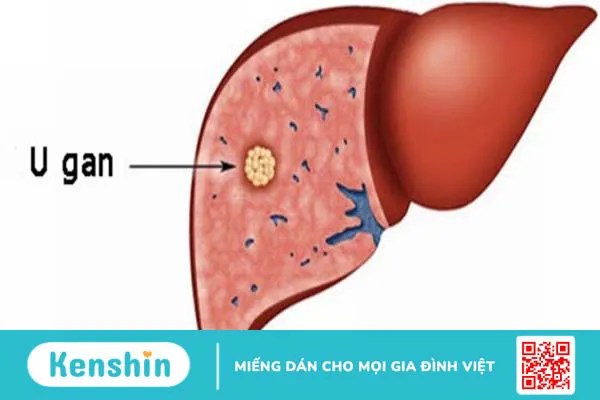 Giải đáp: Siêu âm gan có cần nhịn ăn không? 2