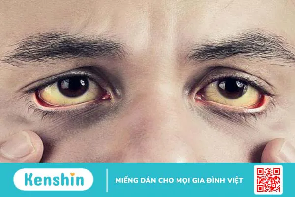 Siêu âm gan mật: Định nghĩa, khi nào cần siêu âm, chẩn đoán bệnh gì? 1