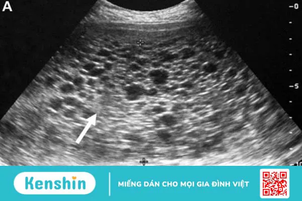 Siêu âm gan mật: Định nghĩa, khi nào cần siêu âm, chẩn đoán bệnh gì? 2