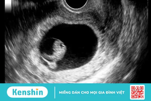 Siêu âm thai 3 tháng đầu và tất tần tật những điều mẹ cần biết 1