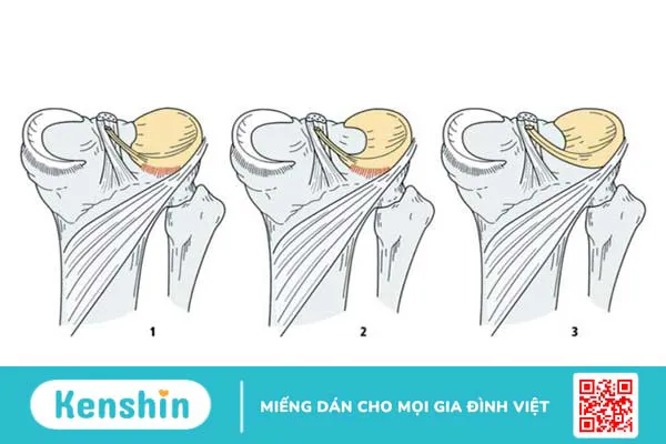 Sụn chêm hình đĩa có mấy loại và biện pháp điều trị như thế nào? 2